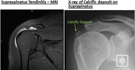 Supraspinatus Tendinitis :Cause,Sign/Symptoms,Physiotherapy Treatment