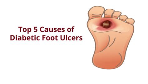 Top 5 Causes of Diabetic Foot Ulcers | Dr Abhilash