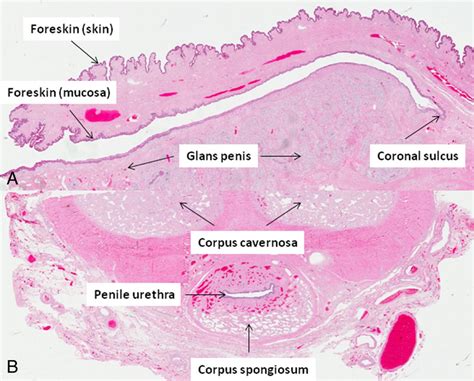 Erythroplasia Of Queyrat Histology