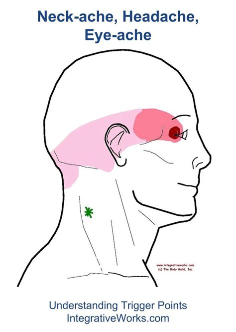 The pain pattern of splenius cervicis that creates that dull headache ...