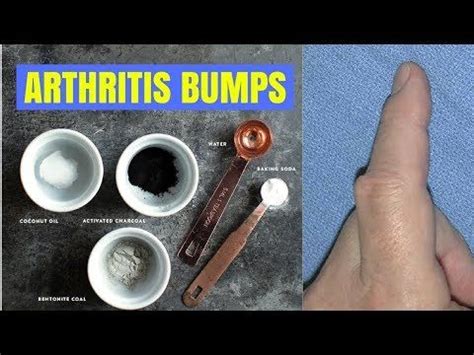 How to get rid of arthritis bumps on fingers naturally – Home remedies for rheumatoid… | Natural ...