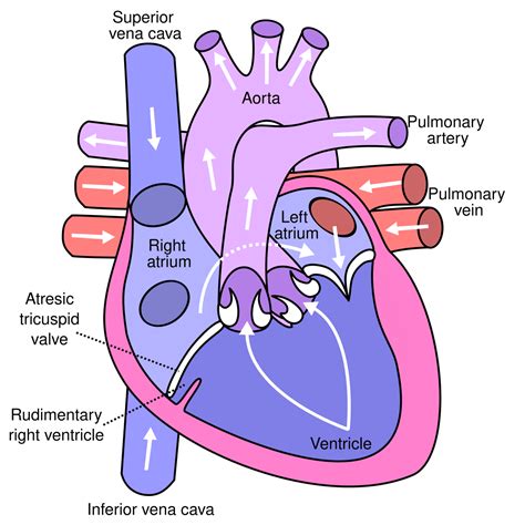 Tricuspid atresia - Wikipedia