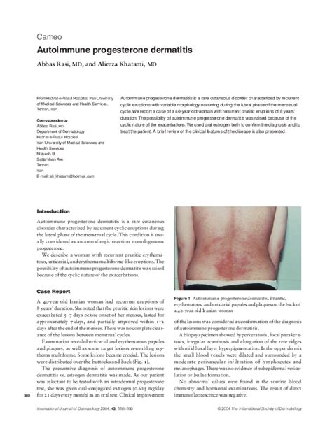 (PDF) Autoimmune progesterone dermatitis | Alireza Khatami - Academia.edu