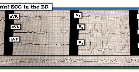 ECG Interpretation: ECG Blog #232 (47) — What is Bigeminy?