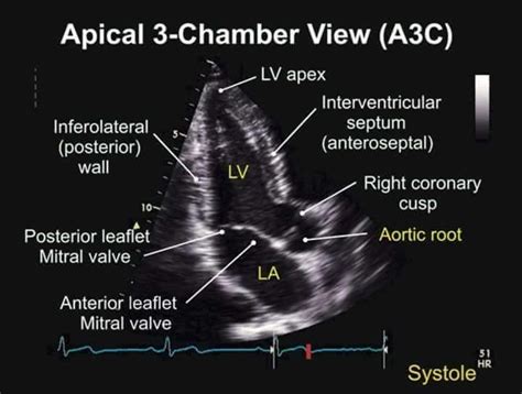 Apical 3 Chamber View TEE | Diagnostic medical sonography, Diagnostic ...