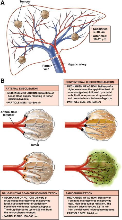 Chemoembolization and Radioembolization for Hepatocellular Carcinoma - Clinical Gastroenterology ...