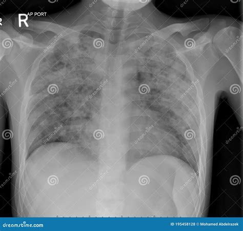 X-Ray of the Chest in a Patient with Active Pulmonary Tuberculosis TB Stock Photo - Image of ...