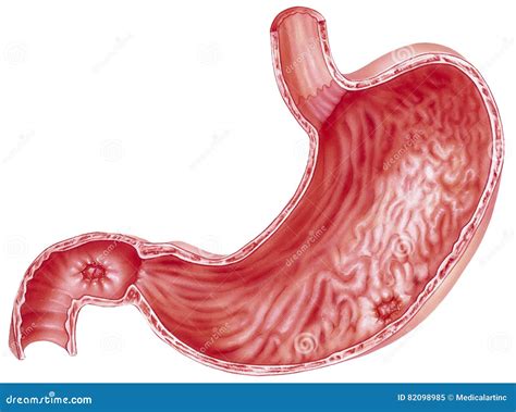 Stomach - Peptic Ulcers stock illustration. Illustration of throat - 82098985