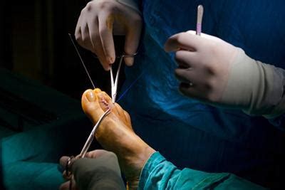 Podiatric Surgery: Procedures for Correcting Foot and Ankle Problems