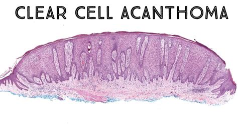 Clear Cell Acanthoma Histology