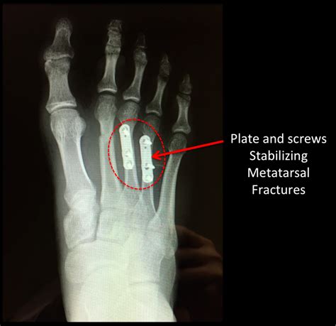 Broken Foot Metatarsal Fracture