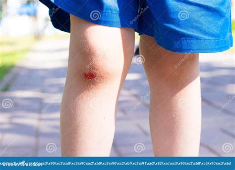 Wound On A Knee Of The Child Royalty-Free Stock Photography | CartoonDealer.com #19840259