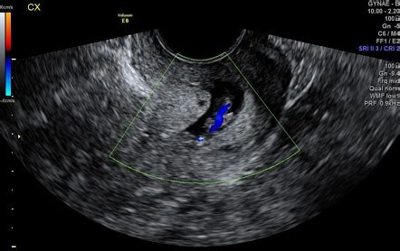 Polyp Cervix Ultrasound