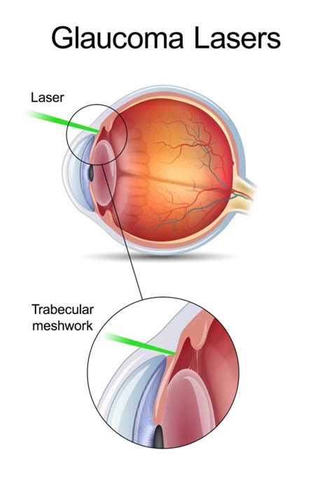 Glaucoma | Seaside Eyes