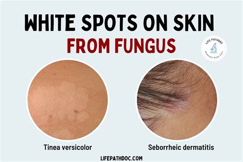 White Spots on Skin from Fungus: What Are They?