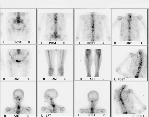 Osteoporosis Bone Scan Images | Osteoporosis bones, Osteoporosis ...