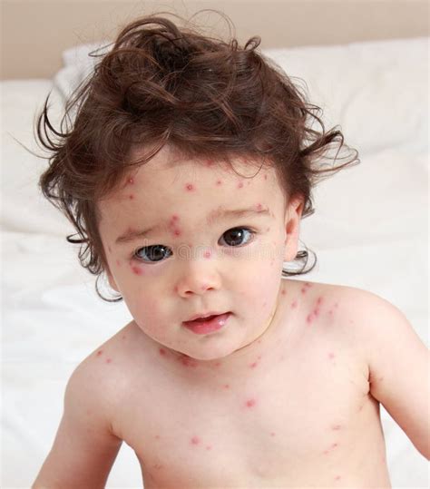 Chicken pox rash stock image. Image of protection, portrait - 25619011