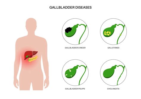 Robotic Surgery for Gallbladder Disease