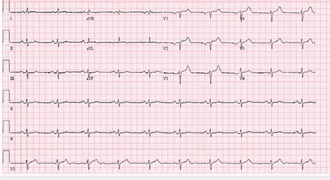 EKG post dual-chamber AICD with atrial-paced rhythm, prolonged AV... | Download Scientific Diagram