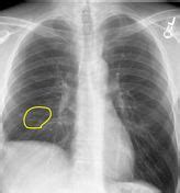 Chest X Ray Pulmonary Embolism