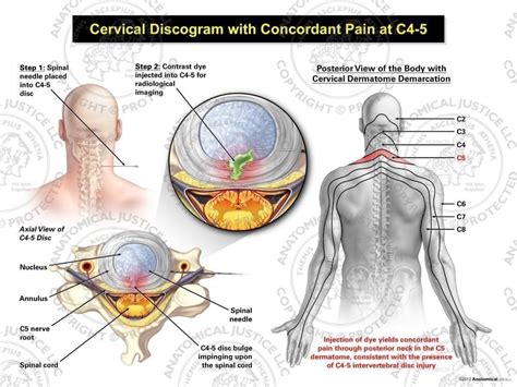 C4 C5 Dermatome