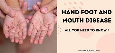 Guide to Hand Foot and Mouth Disease in Kids – omumsie