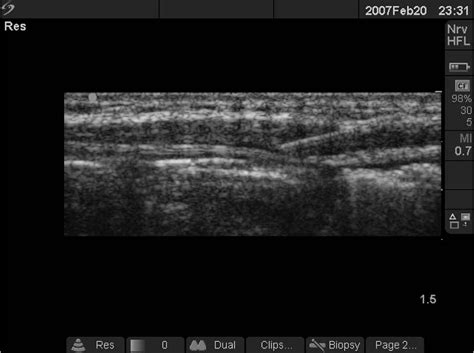 Figure 2 from Ultrasound-guided rectus sheath block and catheter ...