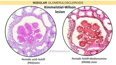 Diabetic Nephropathy - Pathology Made Simple