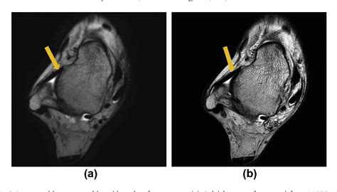 Figure 2 from Three-dimensional isotropic T2-weighted fast spin-echo (VISTA) ankle MRI versus ...