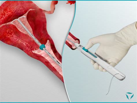 Nuvaring Insertion Diagram - Wiring Diagram Pictures