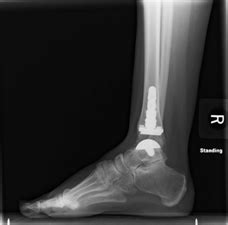 Total Ankle Replacement Surgery (Arthroplasty) Procedure & Recovery