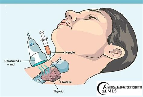 fine needle aspiration biopsy breast | Medical Laboratory Scientist - MLS