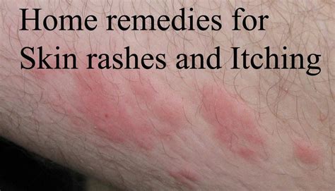Best Home remedies for Skin rashes and Itching | Online bee | Home remedies for skin, Home ...
