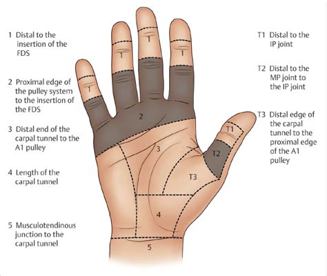 4 Flexor Tendon Repair (Zone 2) | Plastic Surgery Key