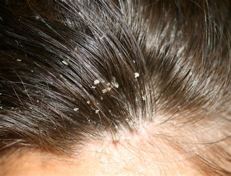 FMS SKIN & HAIR: Best Dandruff Treatment in Hyderabad, India