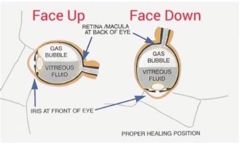 Free TIPS and STRATEGIES for Face down Home Recovery, Positioning ...