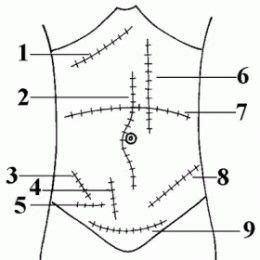 1- kocher incision 2- midline incision 3- McBurney incision 4-Battle ...