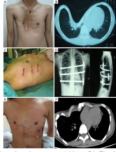 Pectus Excavatum Pectus Forum