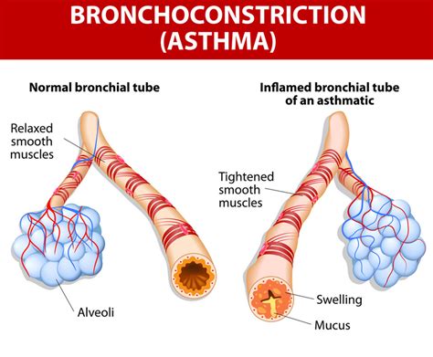 Deliberation of Sympathoadrenal Reactivity in Exercise-induced Asthma