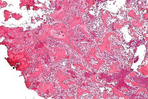 Osteoid Osteoma Histology