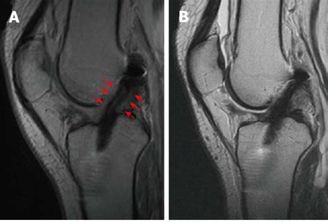 Anterior Cruciate Ligament Mri