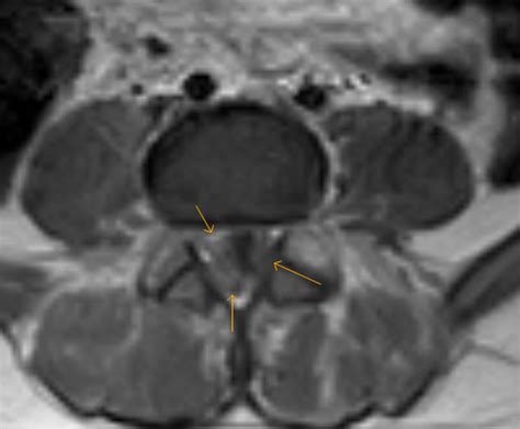 Arachnoiditis-MRI - Sumer's Radiology Blog