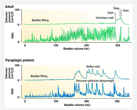 Detrusor pressure with simultaneous EMG of sphincter during slow... | Download Scientific Diagram