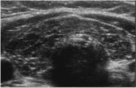 Gray-scale ultrasound images show heterogeneous thyroid parenchyma in a... | Download Scientific ...