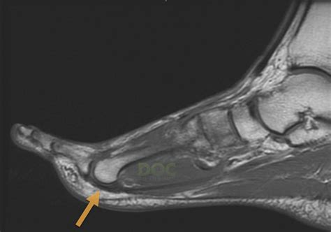 #371 What is thinning of the plantar plate ligament on MRI? - DOC