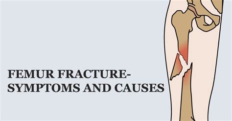 Femur fracture- Symptoms and causes – Welcome to SYS MEDTECH ...