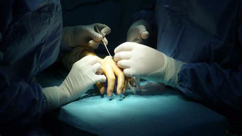 Peripheral Nerve Neurosurgery | Expert Surgeon | Aaron Cohen-Gadol, MD