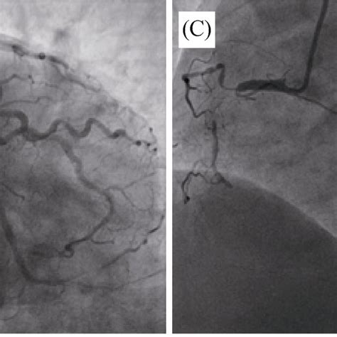 Coronary angiography results. (A): Coronary angiography showed diffuse ...