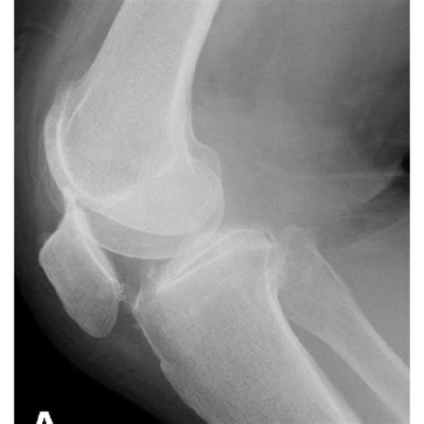 (a) Plain frontal radiography: an intra-articular fracture (arrow) is... | Download Scientific ...