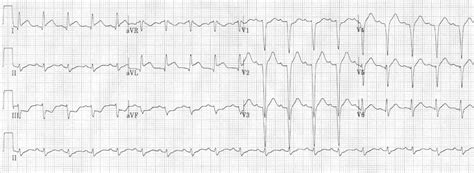 Lateral STEMI ECG changes • LITFL • ECG Library Diagnosis